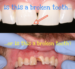 broken tooth better