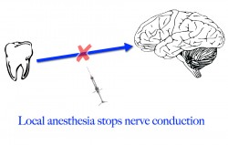 local anesthesia diagram