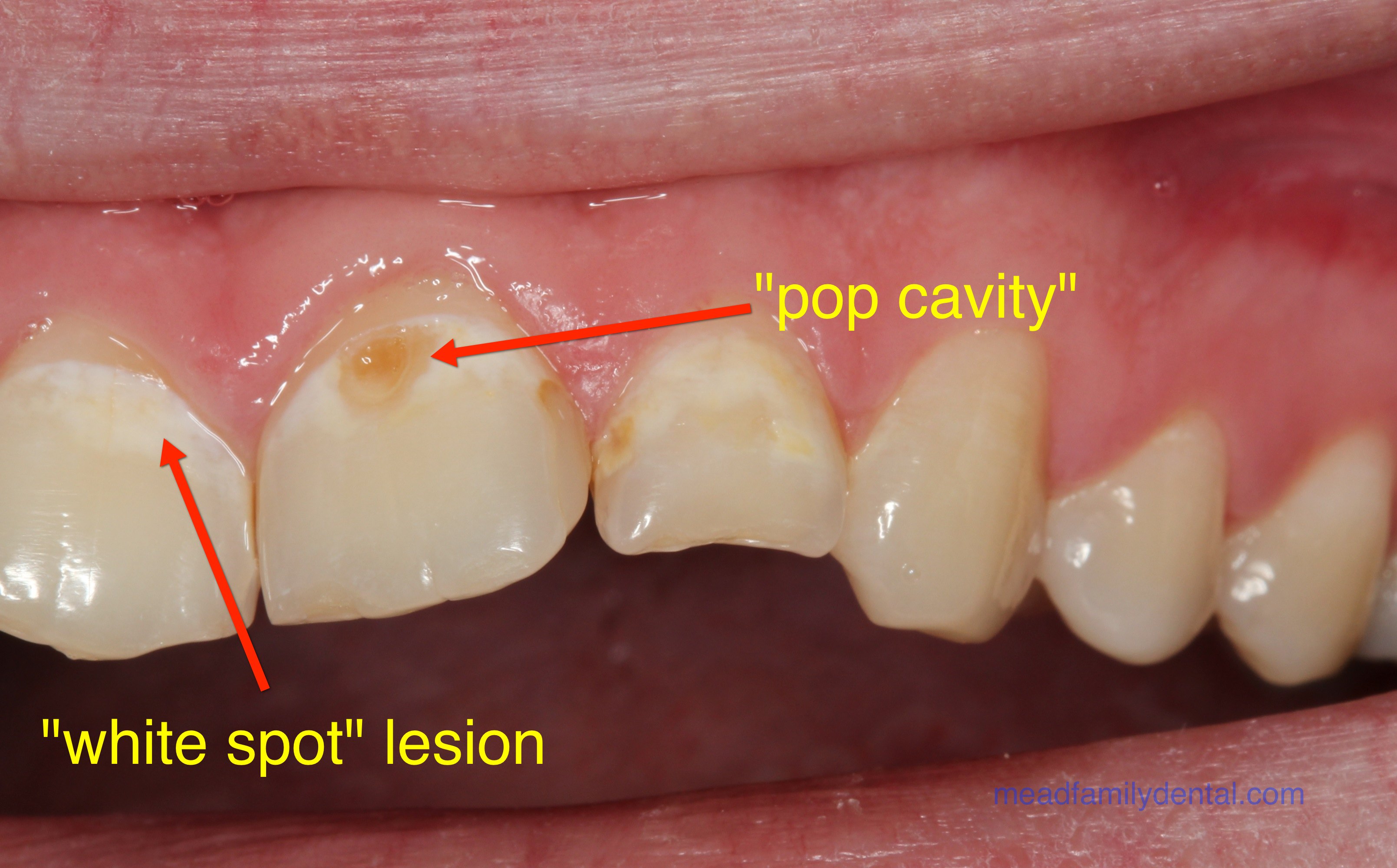 Front Tooth Cavity