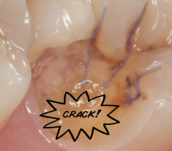 crack tooth final