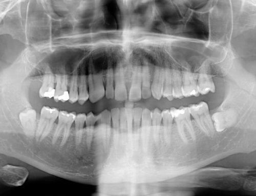 Dental x-rays are safe, effective and they don’t cause cancer