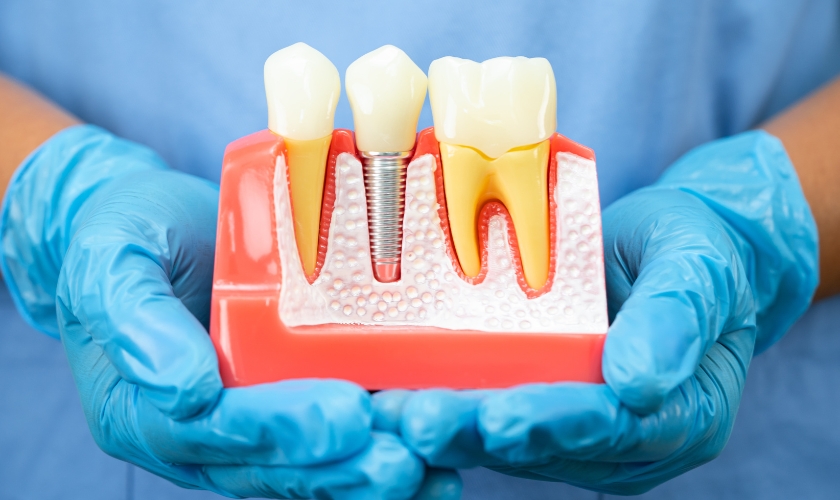 dental implants in Saginaw